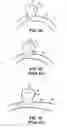 Fig. 04 - Medical device and system having such a device