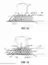 Fig. 11 - Medical device and system having such a device