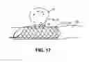 Fig. 14 - Medical device and system having such a device