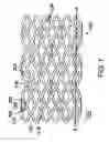 Fig. 10 - BIOABSORBABLE STENT THAT MODULATES PLAQUE GEOMETRIC MORPHOLOGY AND CHEMICAL COMPOSITION