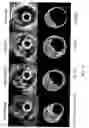 Fig. 13 - BIOABSORBABLE STENT THAT MODULATES PLAQUE GEOMETRIC MORPHOLOGY AND CHEMICAL COMPOSITION