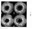 Fig. 14 - BIOABSORBABLE STENT THAT MODULATES PLAQUE GEOMETRIC MORPHOLOGY AND CHEMICAL COMPOSITION