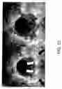 Fig. 15 - BIOABSORBABLE STENT THAT MODULATES PLAQUE GEOMETRIC MORPHOLOGY AND CHEMICAL COMPOSITION