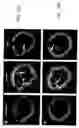 Fig. 16 - BIOABSORBABLE STENT THAT MODULATES PLAQUE GEOMETRIC MORPHOLOGY AND CHEMICAL COMPOSITION