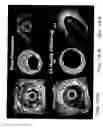 Fig. 19 - BIOABSORBABLE STENT THAT MODULATES PLAQUE GEOMETRIC MORPHOLOGY AND CHEMICAL COMPOSITION