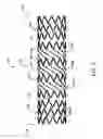 Fig. 03 - Transluminal angioplasty devices and methods of use