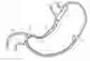 Fig. 01 - Bariatric Device and Method for Weight Loss