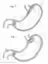 Fig. 02 - Bariatric Device and Method for Weight Loss