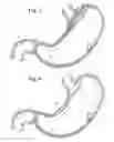 Fig. 03 - Bariatric Device and Method for Weight Loss