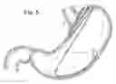 Fig. 04 - Bariatric Device and Method for Weight Loss