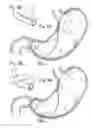 Fig. 06 - Bariatric Device and Method for Weight Loss
