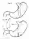 Fig. 07 - Bariatric Device and Method for Weight Loss