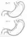 Fig. 08 - Bariatric Device and Method for Weight Loss