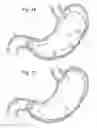 Fig. 09 - Bariatric Device and Method for Weight Loss