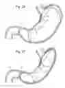 Fig. 16 - Bariatric Device and Method for Weight Loss