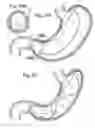 Fig. 20 - Bariatric Device and Method for Weight Loss