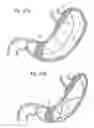Fig. 22 - Bariatric Device and Method for Weight Loss