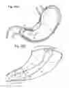 Fig. 28 - Bariatric Device and Method for Weight Loss