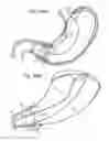 Fig. 32 - Bariatric Device and Method for Weight Loss