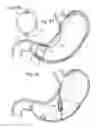 Fig. 33 - Bariatric Device and Method for Weight Loss
