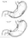 Fig. 34 - Bariatric Device and Method for Weight Loss