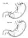 Fig. 35 - Bariatric Device and Method for Weight Loss