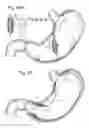 Fig. 37 - Bariatric Device and Method for Weight Loss