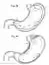 Fig. 40 - Bariatric Device and Method for Weight Loss
