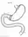 Fig. 41 - Bariatric Device and Method for Weight Loss
