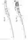 Fig. 43 - Bariatric Device and Method for Weight Loss
