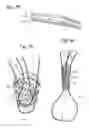 Fig. 45 - Bariatric Device and Method for Weight Loss