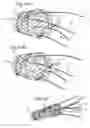 Fig. 46 - Bariatric Device and Method for Weight Loss