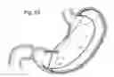 Fig. 47 - Bariatric Device and Method for Weight Loss