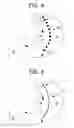 Fig. 04 - MAGNETIC DEVICES AND RELATED METHODS FOR GASTROINTESTINAL RESTRICTION