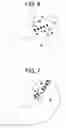 Fig. 05 - MAGNETIC DEVICES AND RELATED METHODS FOR GASTROINTESTINAL RESTRICTION