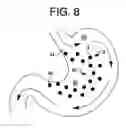 Fig. 06 - MAGNETIC DEVICES AND RELATED METHODS FOR GASTROINTESTINAL RESTRICTION