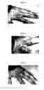 Fig. 03 - Therapeutic Methods And Pharmaceutical Compositions For Treating Warts With Tellurium Compounds
