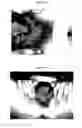 Fig. 06 - Therapeutic Methods And Pharmaceutical Compositions For Treating Warts With Tellurium Compounds