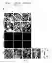 Fig. 07 - Systemic gene replacement therapy for treatment of X-linked myotubular myopathy (XLMTM)