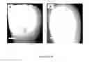 Fig. 08 - Detection and treatment of caries and microcavities with nanoparticles