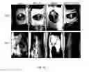 Fig. 21 - Porous polymer scaffold useful for tissue engineering in stem cell transplantation