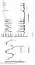 Fig. 12 - Smart tip LVAD inlet cannula
