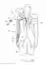 Fig. 06 - Methods to increase the overall diameter of donating veins and arteries