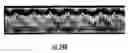 Fig. 35 - MRI and RF compatible leads and related methods of operating and fabricating leads