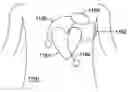 Fig. 01 - Multi-vector sensing in cardiac devices with signal combinations