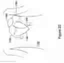 Fig. 23 - Multi-vector sensing in cardiac devices with signal combinations