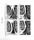 Fig. 17 - Devices and methods for modulation of bone erosion