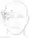 Fig. 01 - Implantable head located radiofrequency coupled neurostimulation system for head pain