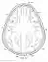 Fig. 34 - Implantable head located radiofrequency coupled neurostimulation system for head pain