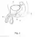 Fig. 02 - SYSTEM TO PRODUCE ANATOMICAL REPRODUCIBILITY AND DETECT MOTION DURING A MEDICAL TREATMENT AND METHODS OF USE